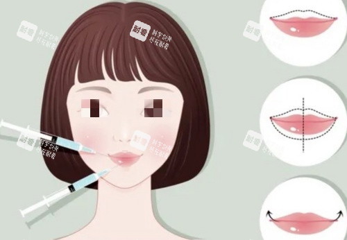 丰唇注射前后示意图