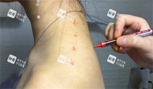 直角肩注射设计