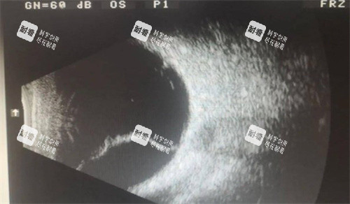 视网膜脱落的眼底