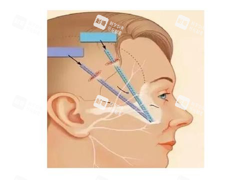 微拉美提升的部位 微拉美提升的部位