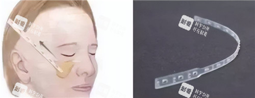 微拉美提升示意图 微拉美提升示意图