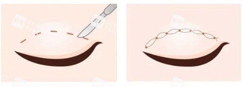 双眼皮切开vs双眼皮埋线 双眼皮切开vs双眼皮埋线