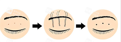 双眼皮三点术过程 双眼皮三点术过程