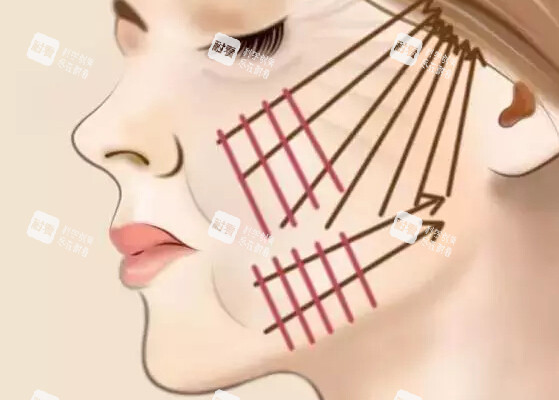 面部埋线提升