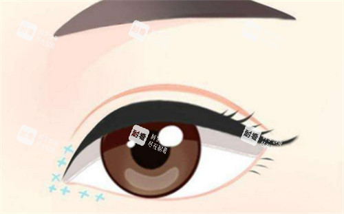 眼综合手术后眼部的样子