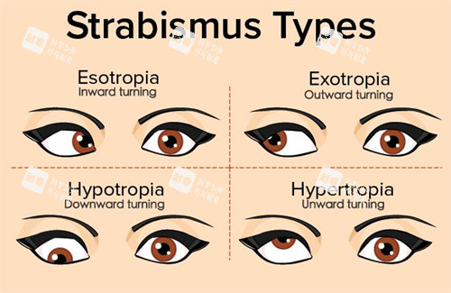 不同情况的眼睛斜视