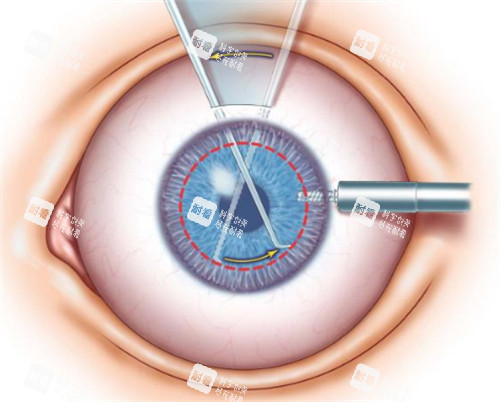 角膜移植切割位置图解 角膜移植切割位置图解