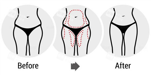 腰腹大腿吸脂前后对比图
