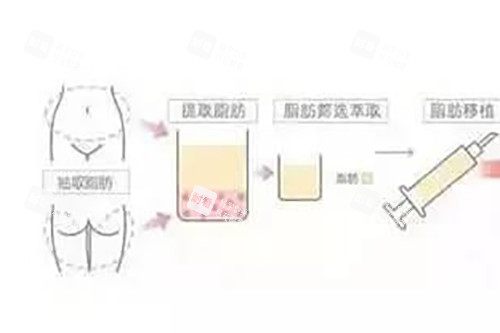 脂肪填充过程示意图