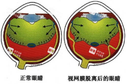 视网膜脱落卡通对比图