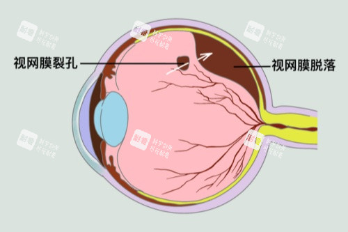 视网膜脱落卡通图