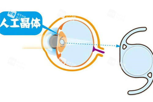 白内障晶体植入