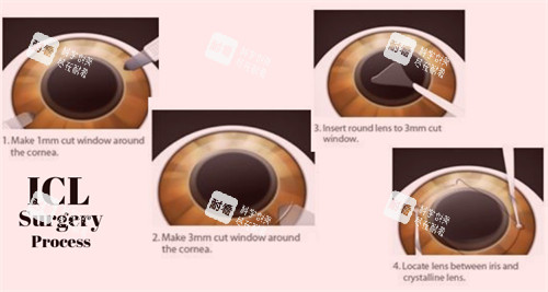 晶体植入手术过程细节图