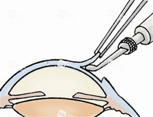 角膜移植手术过程图片