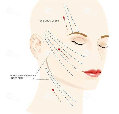 面部提升图解析