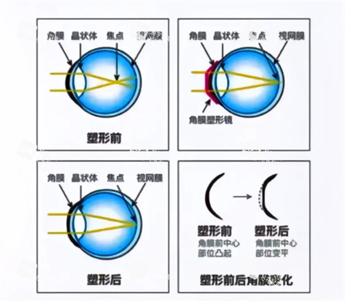 角膜塑形镜佩戴后角膜变化
