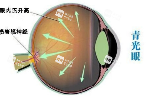 青光眼概念图