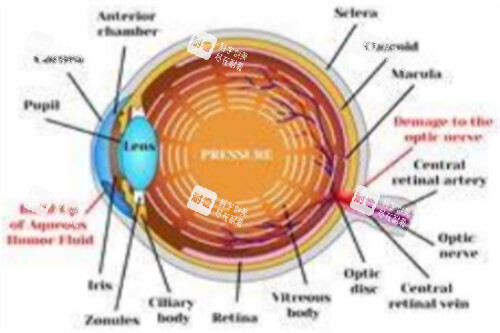 青光眼图示