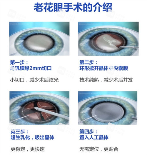老花眼手术的介绍