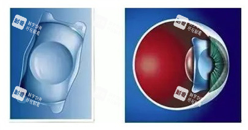 老花眼晶体置换手术