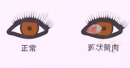 翼状胬肉动画照片