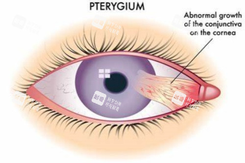 翼状胬肉高清示意图