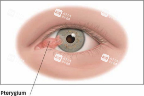 翼状胬肉眼睛示意图