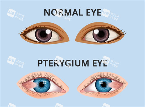 翼状胬肉和正常眼睛的区别