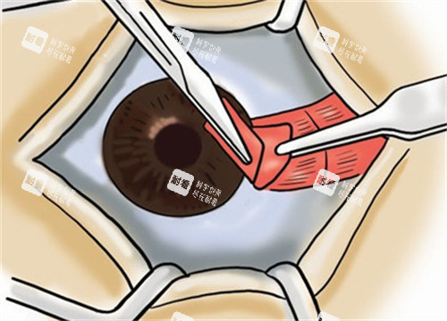 翼状胬肉手术过程图解