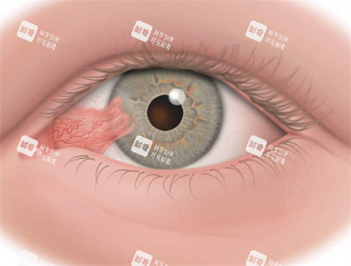 翼状胬肉的样子图片