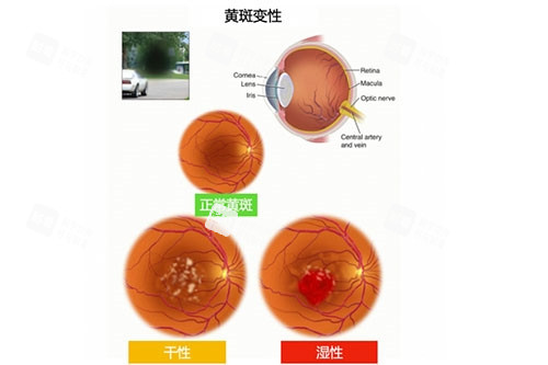 黄斑变性类别图片