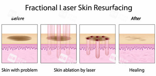激光祛斑流程图