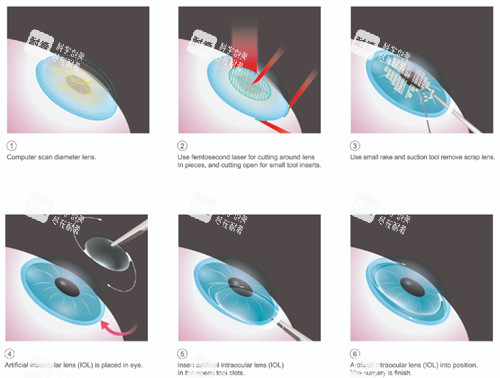 近视晶体植入中 近视晶体植入中