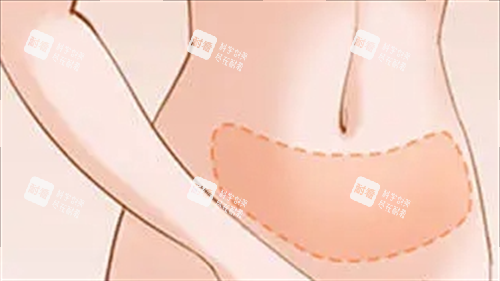 腹部吸脂成效展示图