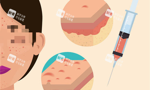 面部改善注射图