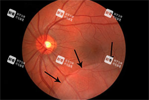 视网膜劈裂手术展示图