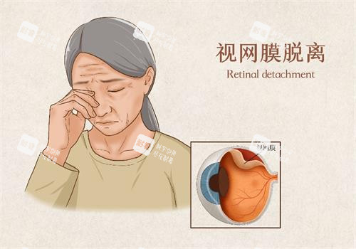 视网膜脱落示意图.