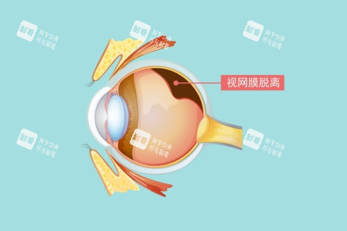 视网膜脱落图片展示