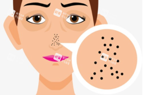 鼻子毛孔粗大卡通图