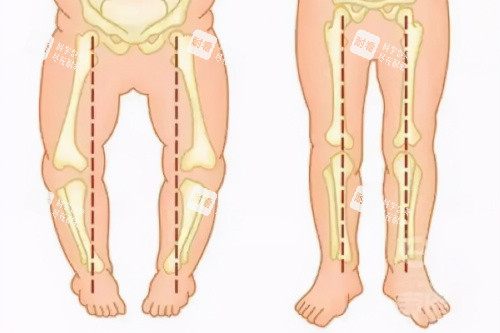 O型腿与正常腿型对比图