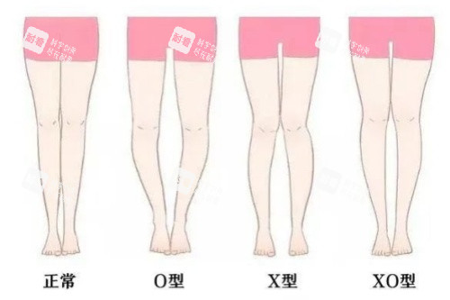 腿型卡通对比图