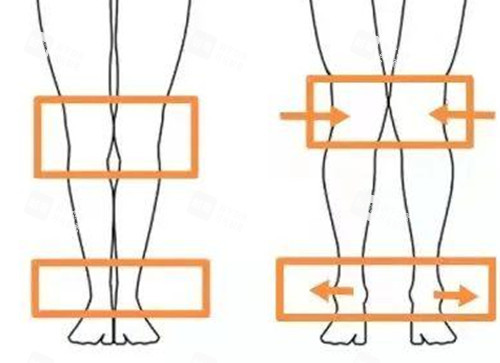 X腿型和正常腿型结构示意图