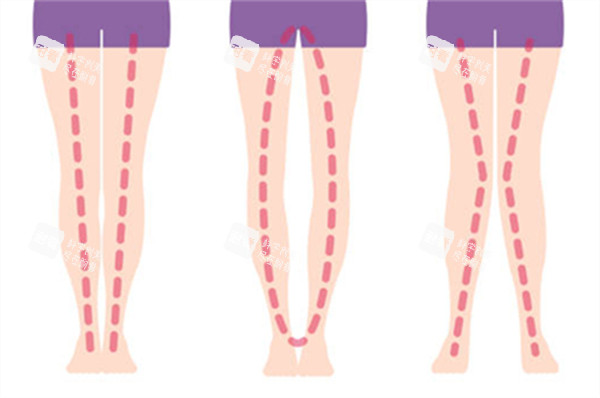 不同腿型的样子图解