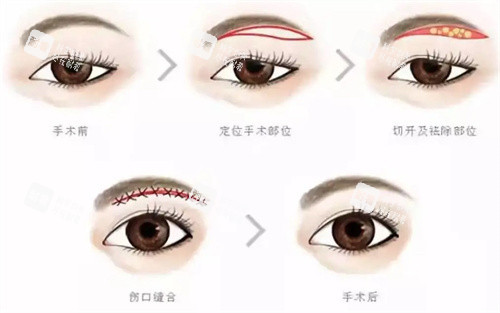提眉手术步骤