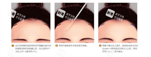 内视镜提眉手术动画演示图