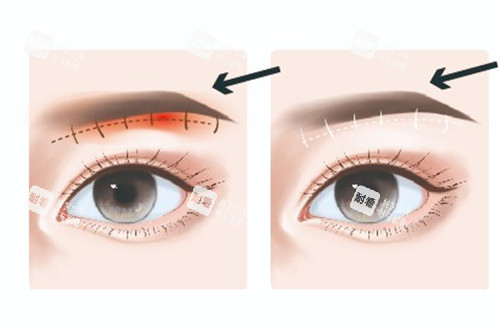 提眉术前术后对比动画图