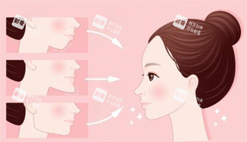 面部轮廓整形 面部轮廓整形