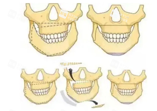 正颌手术卡通照片