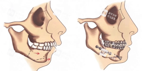 正颌手术前后图 正颌手术前后图