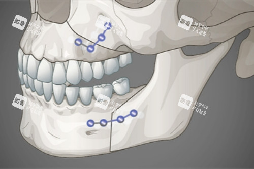 双鄂手术概念图